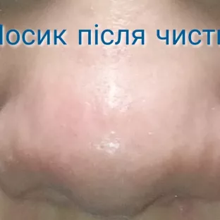 Мануальна чистка обличчя 
