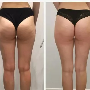 Результати після курсу масажів. До/після